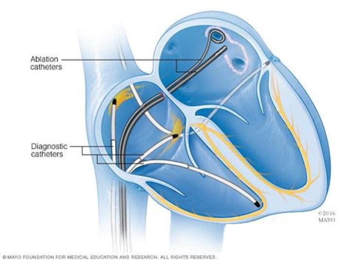 Cardiac Ablation for Atrial Fibrillation CME