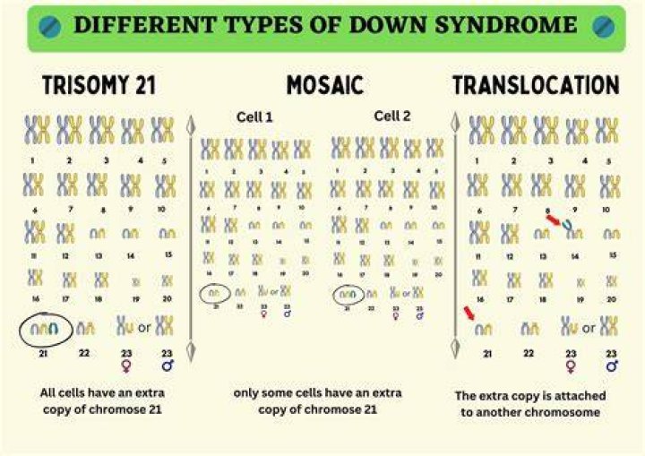 Down Syndrome in Babies Types, Causes & Treatment