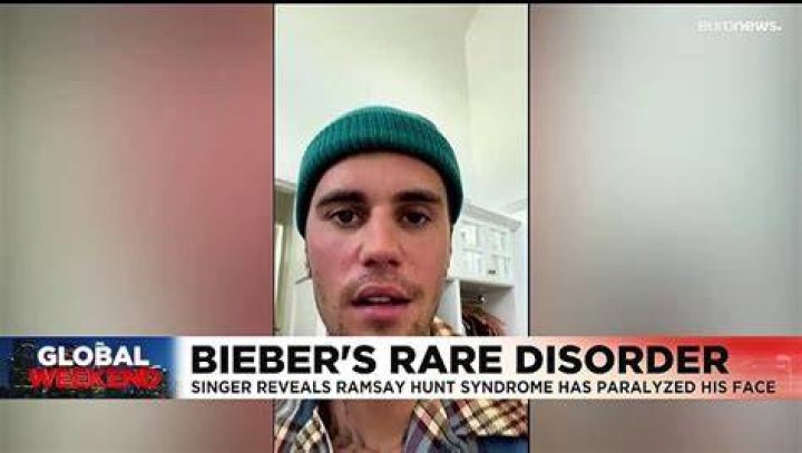 Justin Bieber reveals rare disorder behind facial paralysis AP News