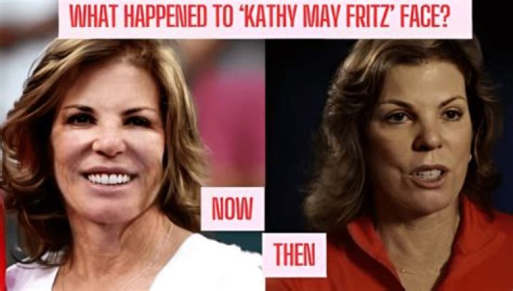 Kathy May Fritz face Surgery What's the deal with her face Surgery