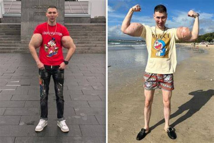 Meet Kirill Tereshin Real Life Popeye Who Injected Synthol In His Cheeks