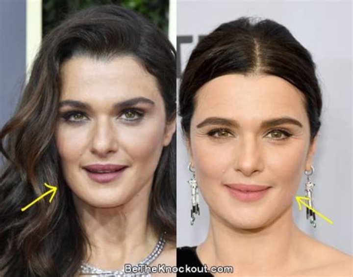 Rachel Weisz Facelift Plastic Surgery Before And After Photos
