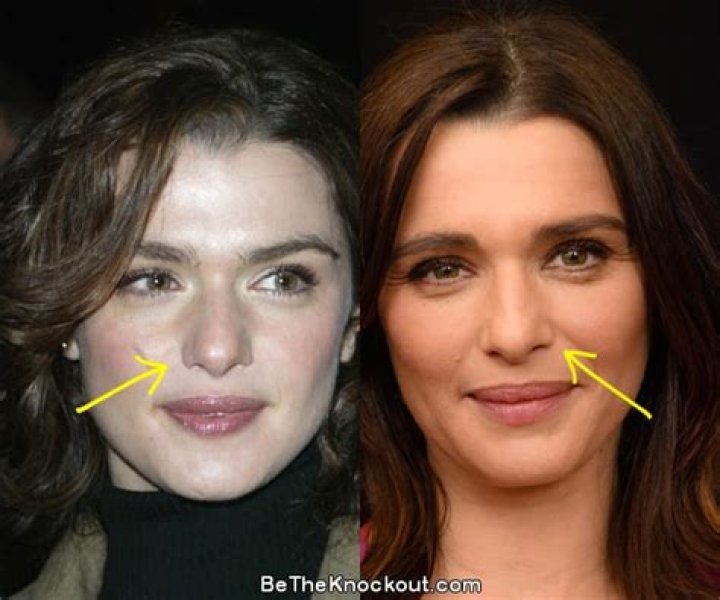 Rachel Weisz Plastic Surgery: A Comprehensive Insight