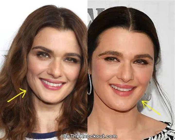 Rachel Weisz Plastic Surgery Before and After Pictures 2024