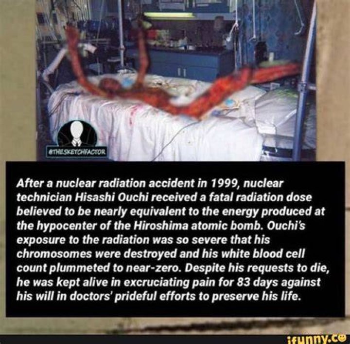 Radioactive Hisashi Ouchi Wikipedia, Biography, Death Causes, Skin