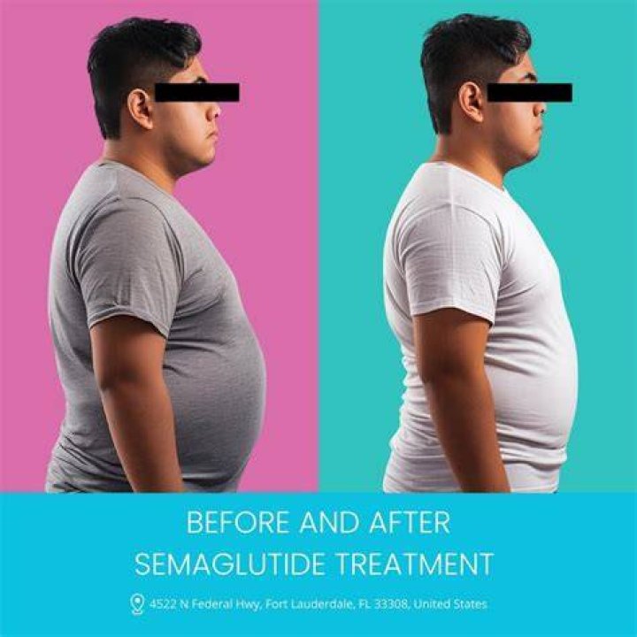 Semaglutide in Pinewood FL for Weight Loss Alternative for Ozempic