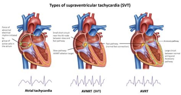 SVT Ablation Melbourne Heart Group
