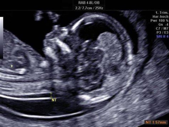 Top 17 down syndrome ultrasound 20 weeks 2022