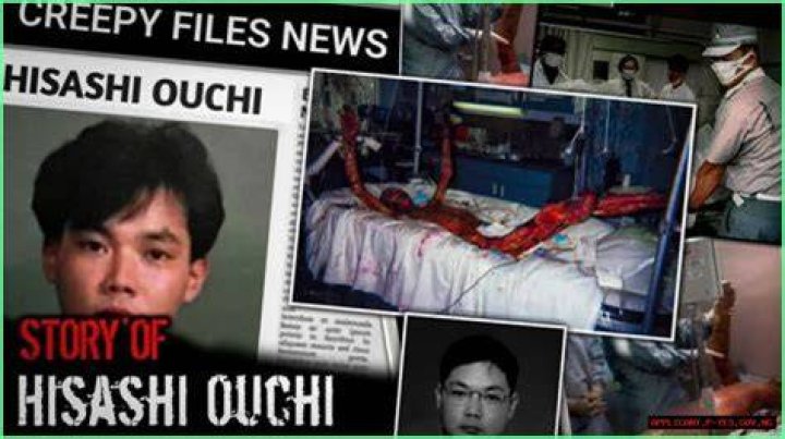 Understanding The Devastating Injuries Of Hisashi Ouchi: A Deep Dive