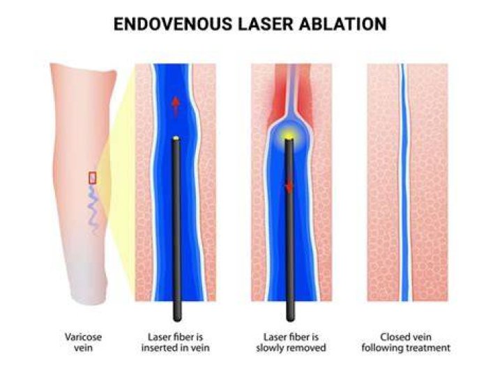 Vein Ablation Align Health & Wellness