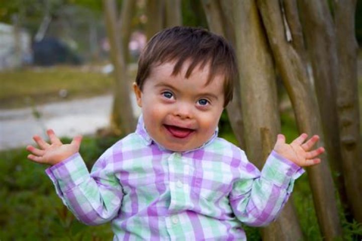 What is Down Syndrome? Shreeansh Fetal medicine center