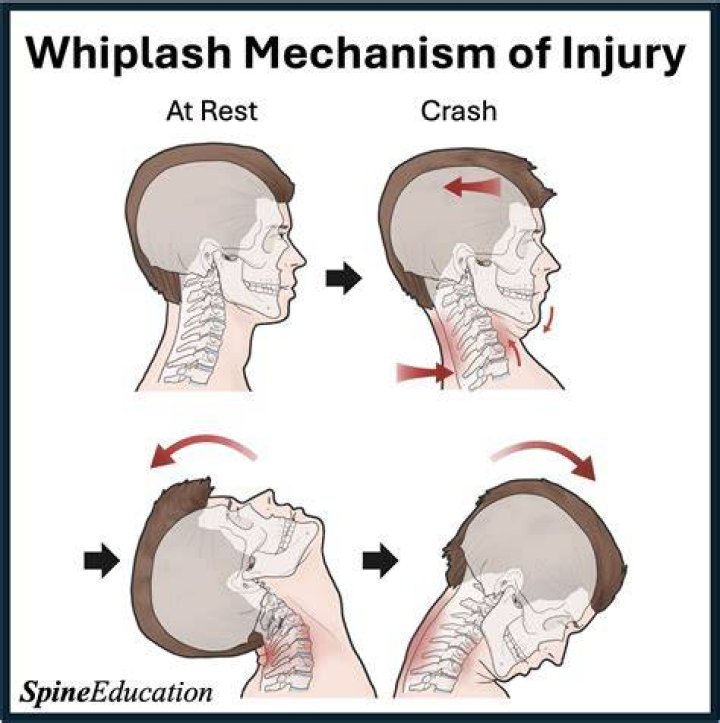 Whiplash